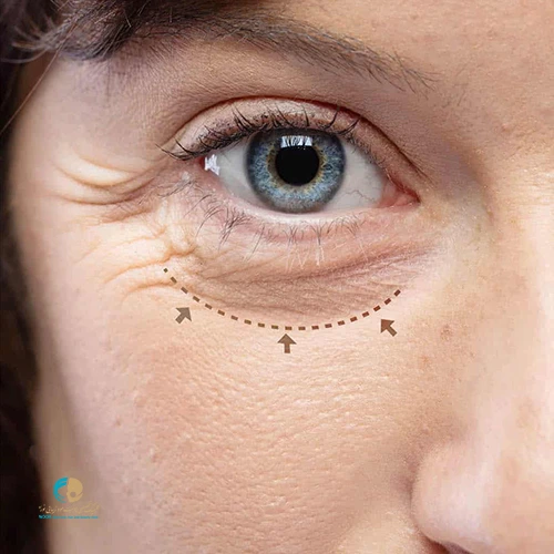 عمل جراحی بلفاروپلاستی پلک