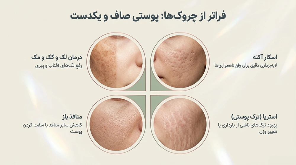 موارد استفاده از لیزر فوتانا برای بهبود پوست